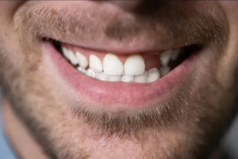 A Missing Tooth Can Change More Than Just Your Smile